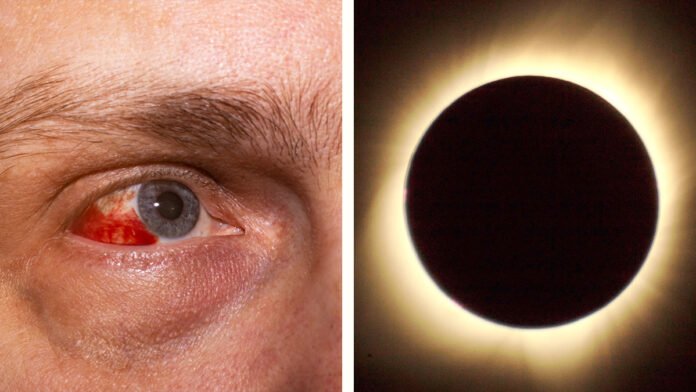 ‘Ceguera por eclipse’